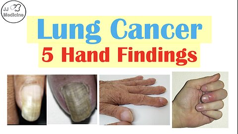 5 Hand Changes That Could Signal Lung Cancer (Don’t Ignore #3)