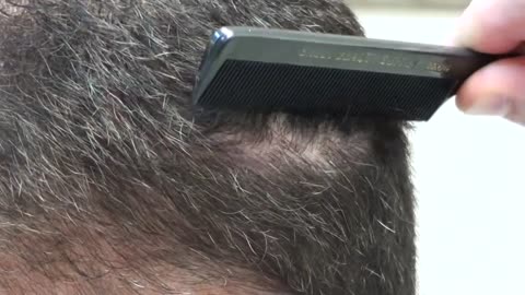 Dr. Brett Bolton Shows Undetectable Hair Restoration Suture Line