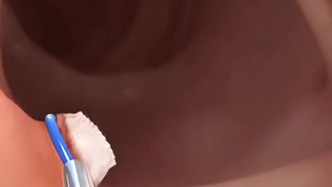 How Colon Polyps Are Removed – Life-Saving Surgery Explained!