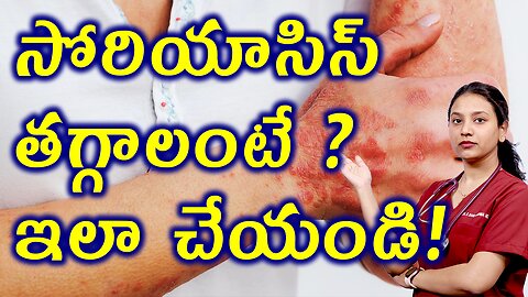 సోరియాసిస్ తగ్గాలంటే ఇలా చెయ్యండి Best Homeopathy Treatment for Psoriasis Solution Cure | హోమియోపతి