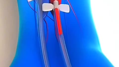 How Dialysis Works – Life-Saving Procedure for Kidney Patients!