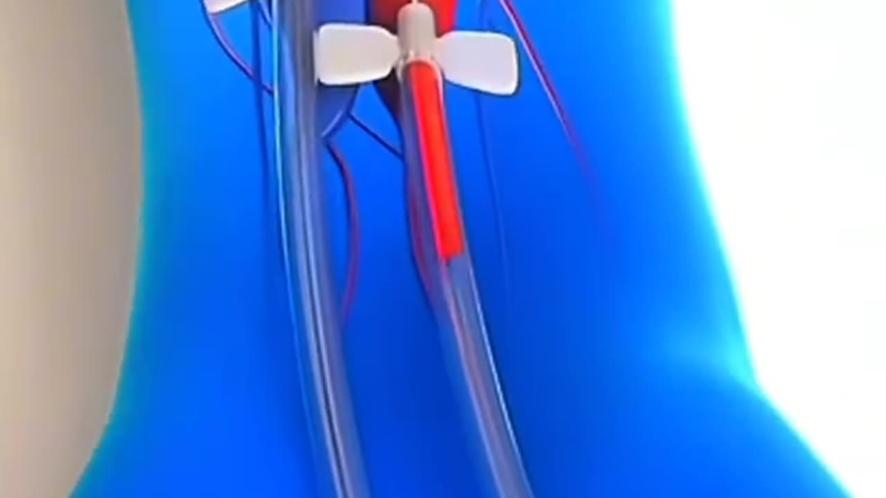 How Dialysis Works – Life-Saving Procedure for Kidney Patients!