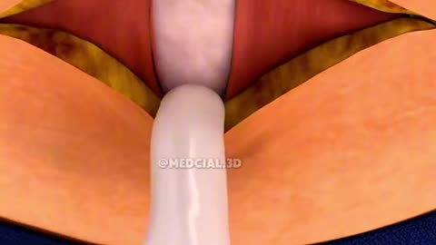 Cesarean Section (C-section)