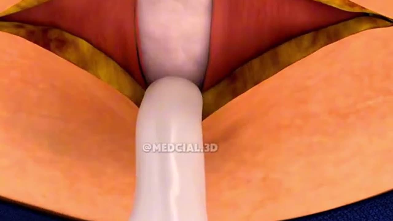 Cesarean Section (C-section)