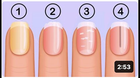 "Health Indicators: 5 Insights Your Nails Provide"