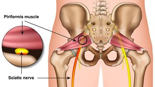 overcoming piriformis syndrome
