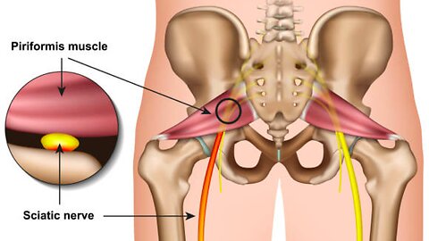 overcoming piriformis syndrome
