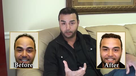 Dr. Brett Bolton Corrective Hair Surgery Bad FUE Scars Corrected