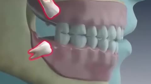 Wisdom Teeth Extraction (3D Animation)