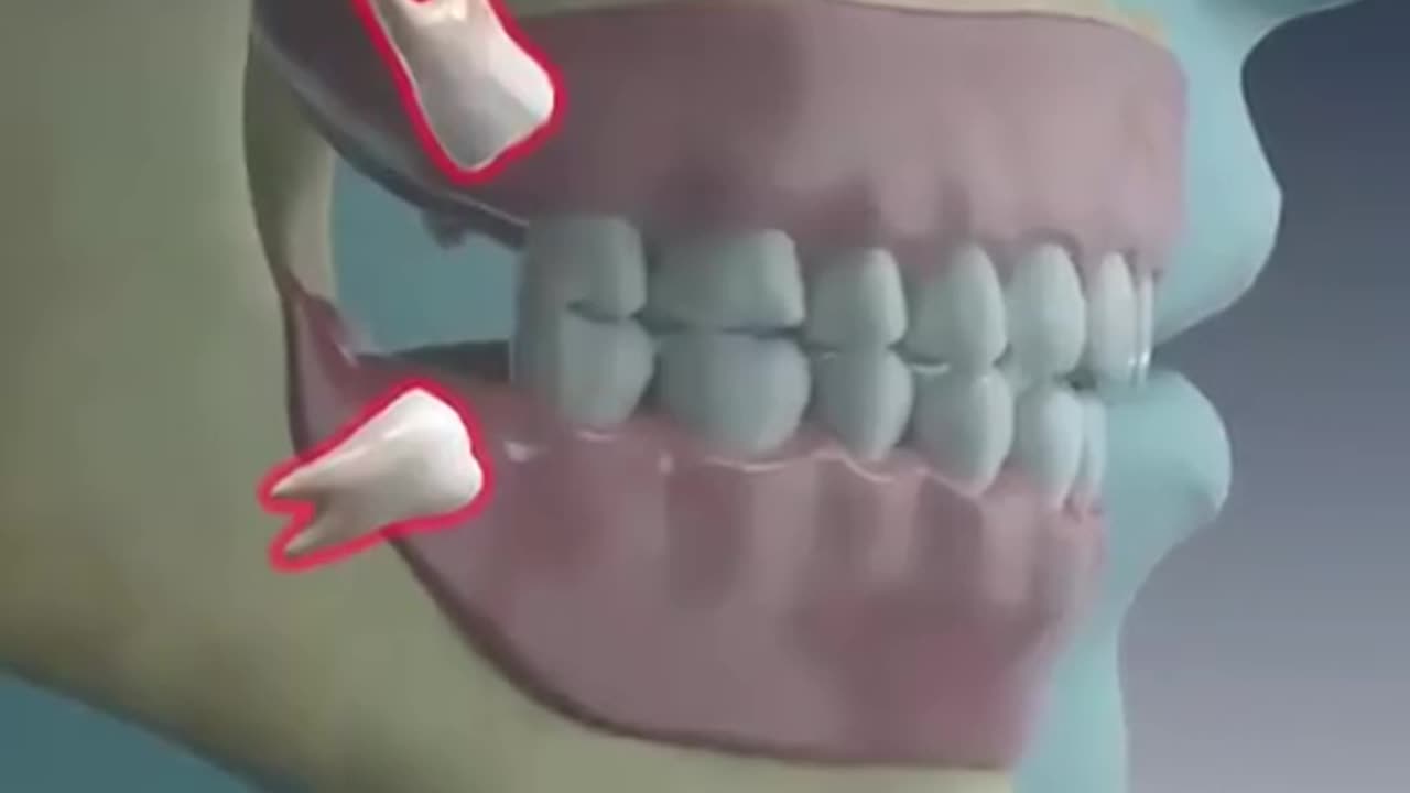 Wisdom Teeth Extraction (3D Animation)