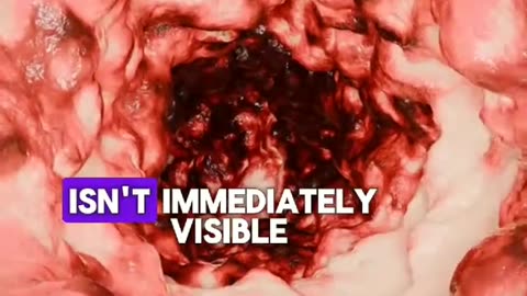 5 Signs of Colon Cancer Early Detection Saves Lives