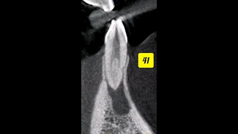 Dental CBCT scan