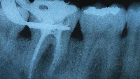 "Understanding the Impact of Root Canals on Dental Meridians by Dr. Dawn Ewing, PhD"