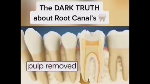 "Unveiling the Dark Secrets of Dentistry: The Hidden Truth Behind Root Canal Procedures"