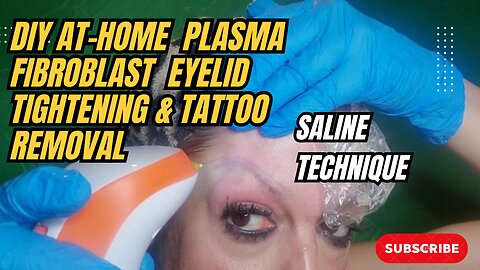 DIY at Home Plasma Fibroblast Eye Lid Tightening & Tattoo Removal.