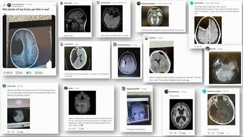 "Understanding the Impact of mRNA Vaccines on Brain Health: Unveiling the Truth"