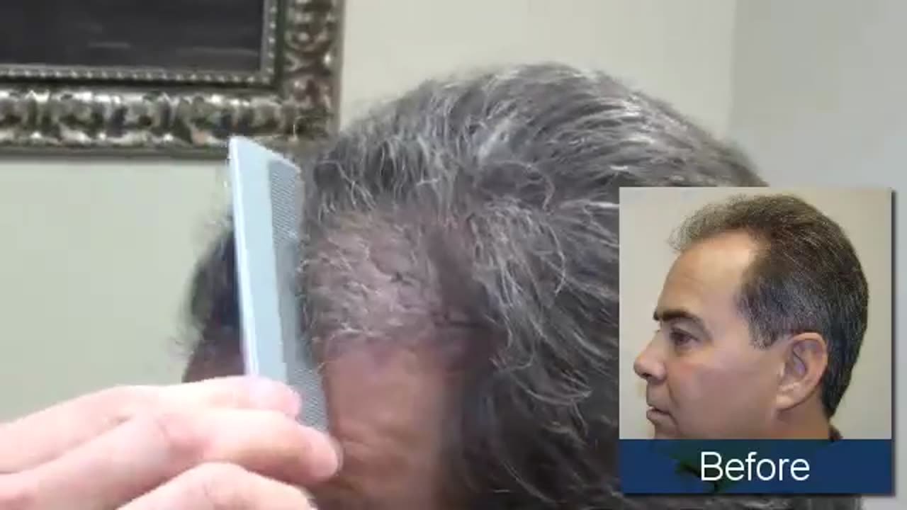 Dr. Brett Bolton How Does It Look Once the Hairs Start Growing in About 4 Months?