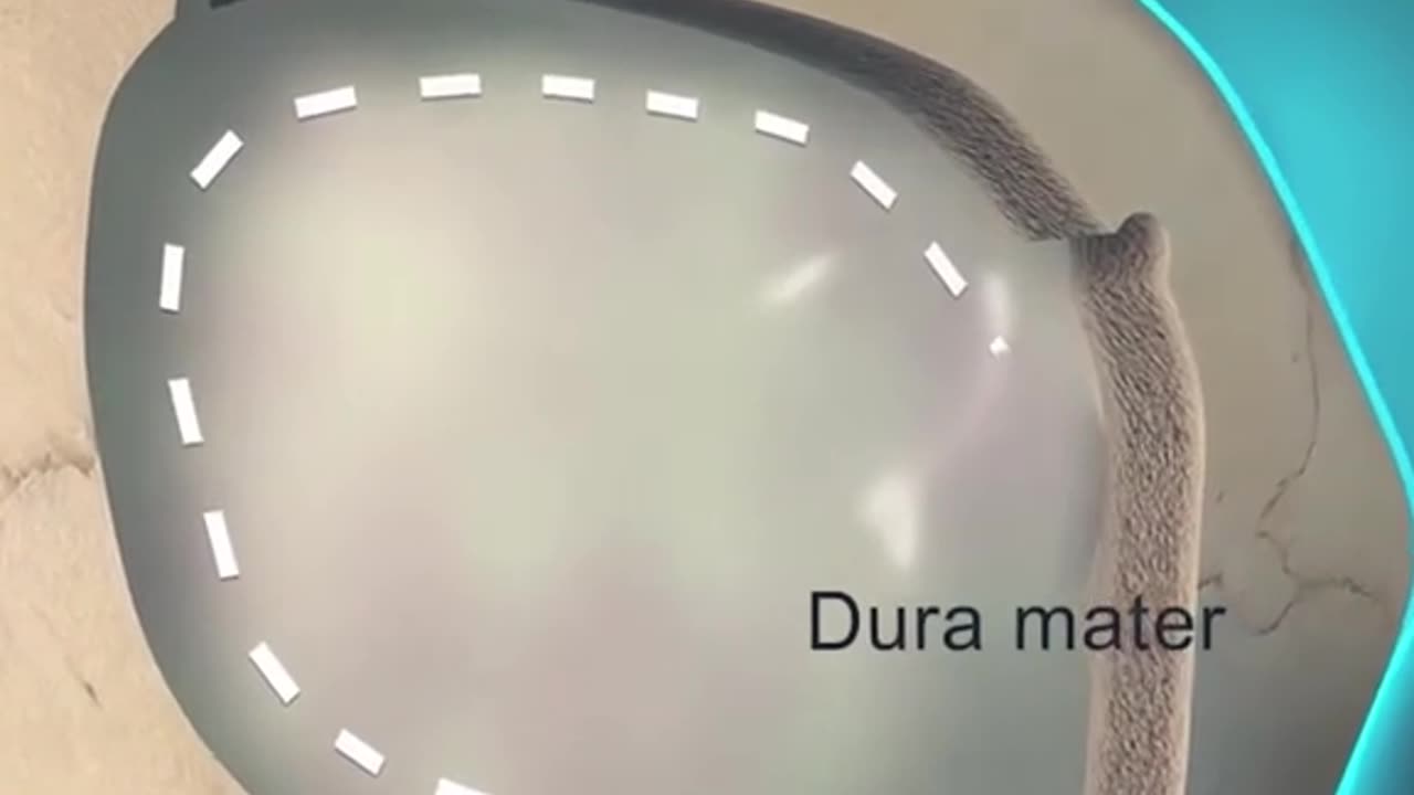 Brain Tumor Removal Surgery (3D Animation)