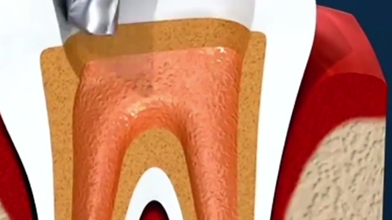 Root canal treatment