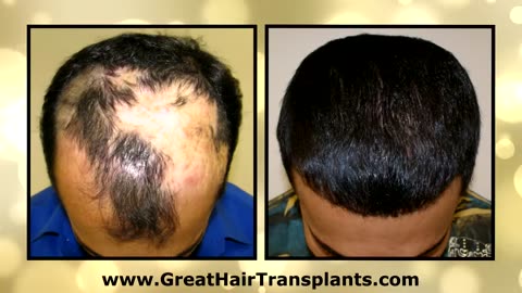 Dr. Brett Bolton | World-Renowned Hair Restoration Surgeon
