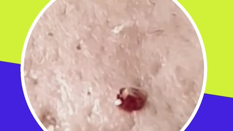 Blackhead removal new this week (ASMR) #18 #shorts