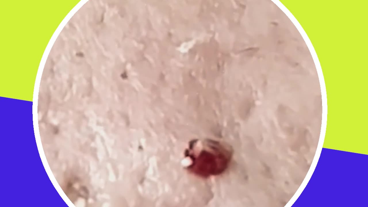 Blackhead removal new this week (ASMR) #18 #shorts