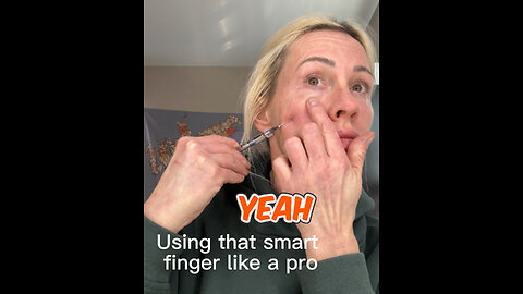 Fine Filler Nasojugal Groove with Cannula