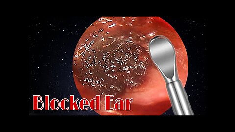 BIGGEST Ear Wax, Difficult Removal - EP3 _part1_2v
