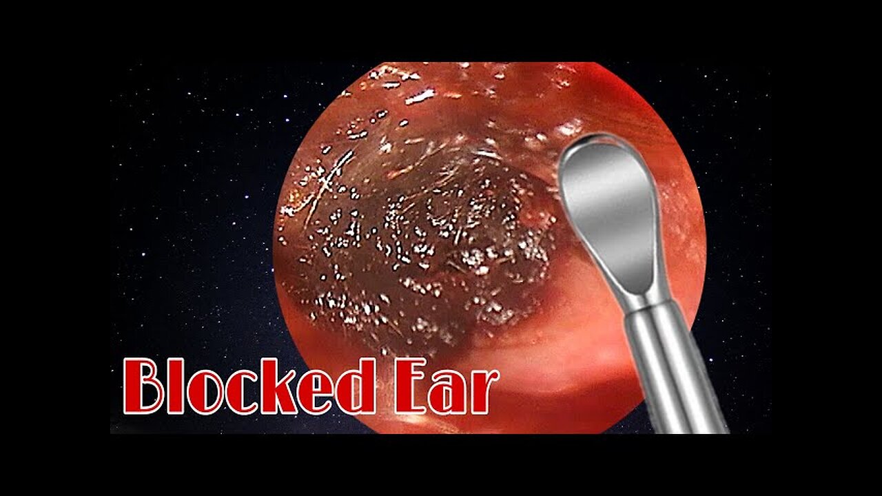 BIGGEST Ear Wax, Difficult Removal - EP3 _part1_2v