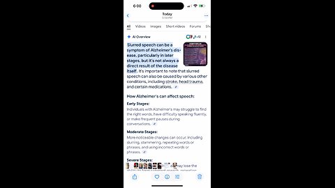 Alzheimers Disease symptoms-- slurred speech--shown by Pres. Trump. 5-30-25
