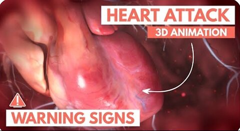 Recognising a heart attack | 3D Animation