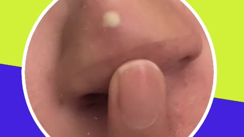 Pimple removal satisfying video (ASMR) #19 #shorts