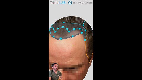 Getting his first Hair Transplant at 44!