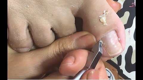 Cleaning is very needed! Home Service Pedicure Series #ingrowntoenail #toenails #pedicure (5)