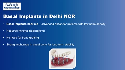 Affordable Dental Implants in Delhi NCR – Basal, Titanium & Zirconia at Dr. Garg’s Center