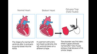 "Broken Heart Syndrome"