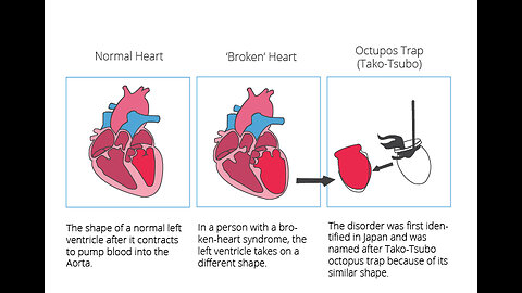 "Broken Heart Syndrome"