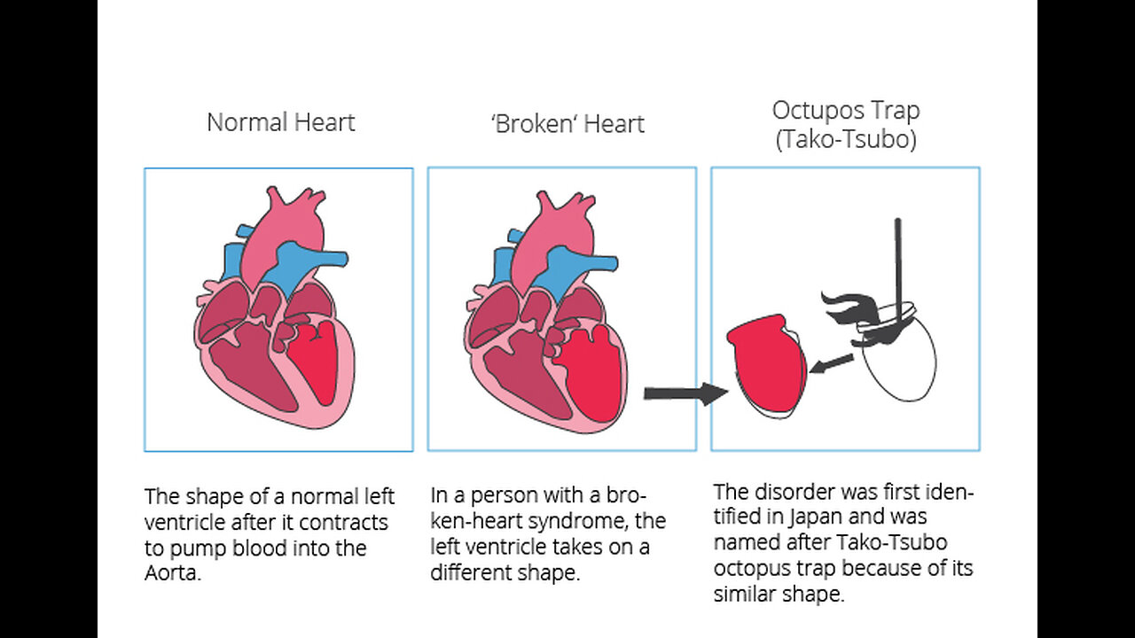 "Broken Heart Syndrome"