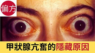 6 個被忽略的甲狀腺亢進隱藏原因