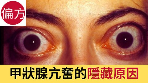 6 個被忽略的甲狀腺亢進隱藏原因