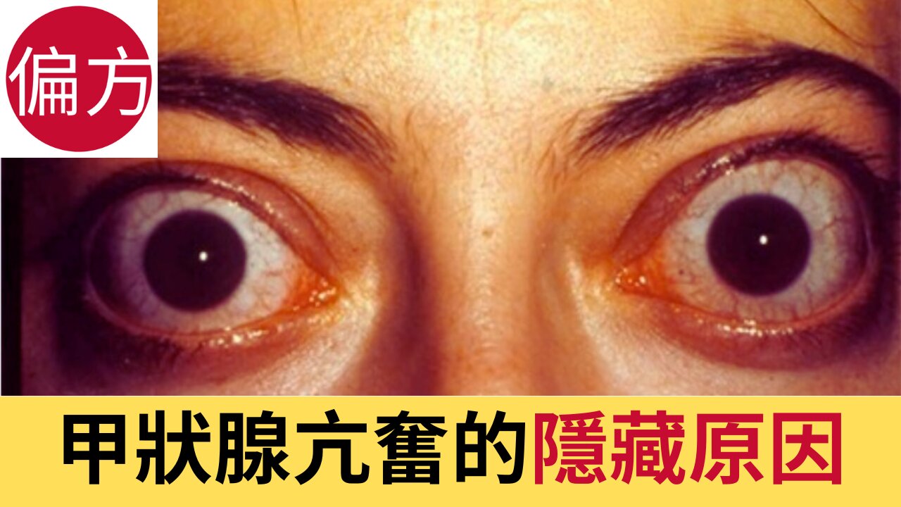 6 個被忽略的甲狀腺亢進隱藏原因