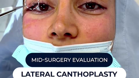 Awake Lateral Canthoplasty Mid-surgery | Part 2