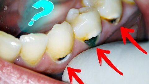 How to Stop bleeding gums and Get rid of cavities