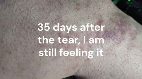 Tore My Hamstring