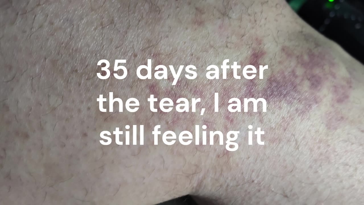 Tore My Hamstring