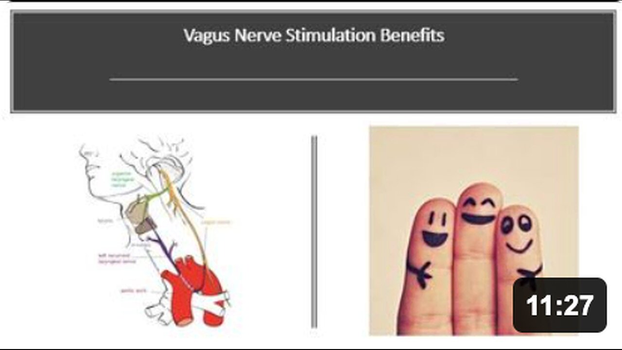 Vagus Nerve Stimulation