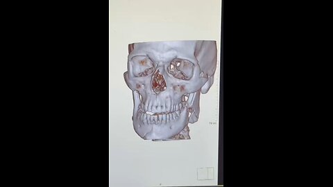 The broken jaw
