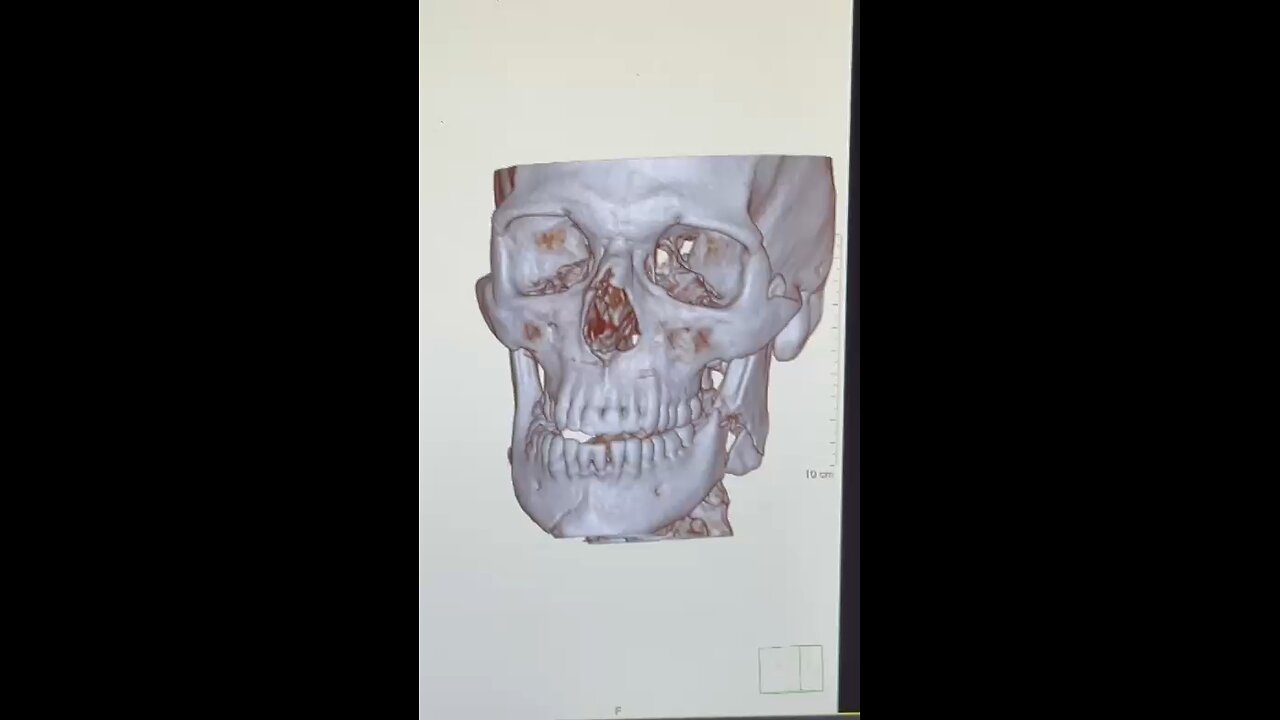 The broken jaw
