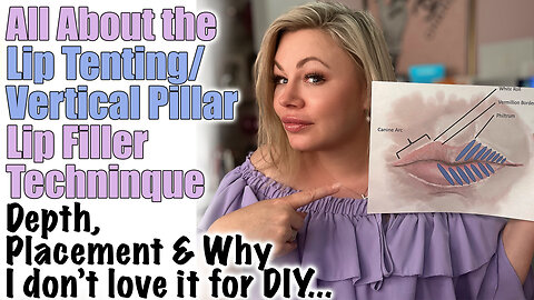 All About Lip Tenting/ Vertical Pillar Lip Filler Technique: Depth, Placement and Why it Works!