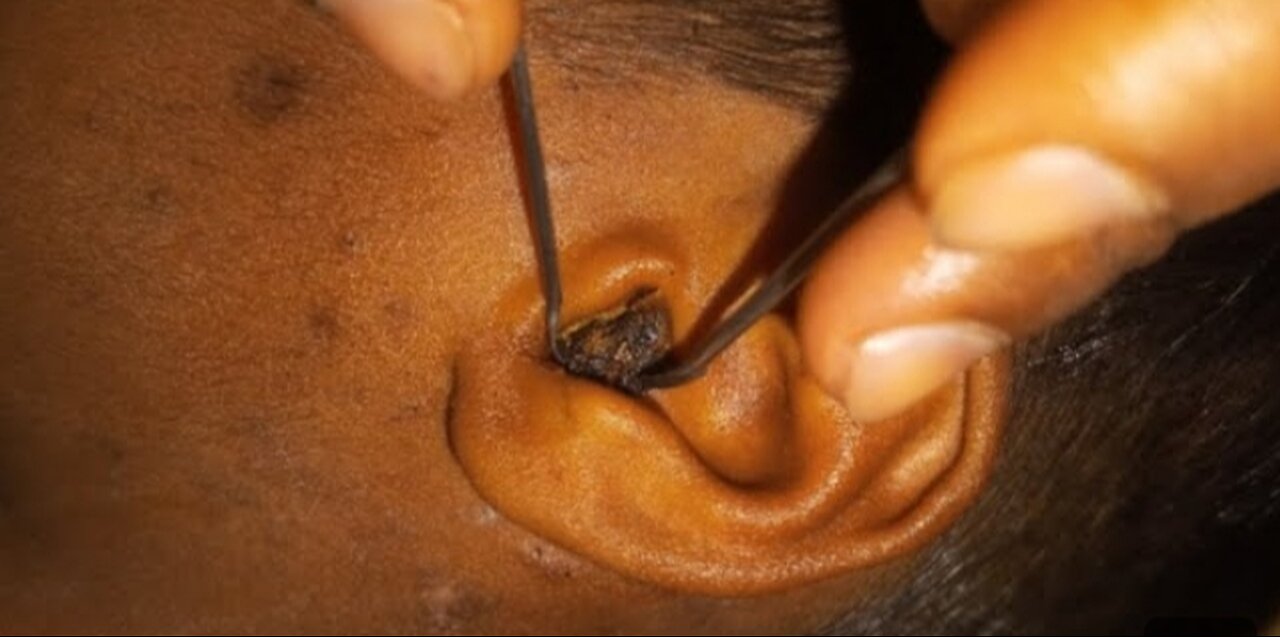 Ear Wax Removal